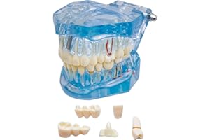 Windplusya Transparent Disease Teeth Model with Dental Implant Bridge, Dental Teach Crown Bridge Removable Model, Tooth Model for Patient and Dental Student Education. (blue)