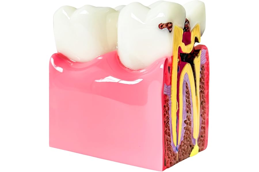 Dental Caries Teeth Model, 3.4 x 3 x 2 Inches - 6 Times Enlarged Dental Anatomy Education Tooth Model - Caries Teaching Typodont Tool for Dentists, Patients, Teachers, and Students