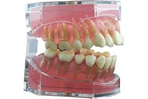 BUYZG Modello di denti per impianti dentali, con gomma morbida e denti in resina rimovibili estraibili per la pratica e l'insegnamento