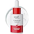 Chemist At Play 2% Salicylic Acid Face Serum | Treats Active Acne | Controls Excess Oil | Removes Blackheads, Pimple & Dark Spots | Fades Acne Marks | Improves Skin Texture | 30ml