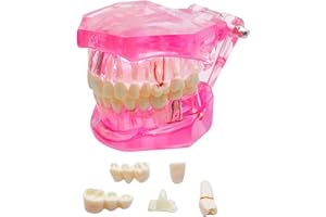 Windplusya Transparent Disease Teeth Model with Dental Implant Bridge, Dental Teach Crown Bridge Removable Model, Tooth Model for Patient and Dental Student Education. (Red)