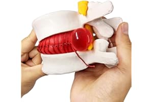 EVOTECH SCIENTIFIC Human Herniated Disc Model, Anatomical Herniated Lumbar Vertebrae Disc Prolapse Model for Medical Teaching Learning, Kids Learning Education Display Toolning, Kids Learning Education Display Tool