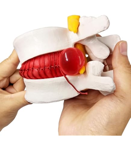 thumbnail image 2 of Anatomical Lumbar Spine Model - 1:1.5 Scale Degenerative Disc Demonstration Model 2 of 6