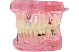 Dentalmall Teeth Model Teeth Typodonts Dental Implant Study Analysis Demonstration Teeth Model #2001 with Restoration Pink
