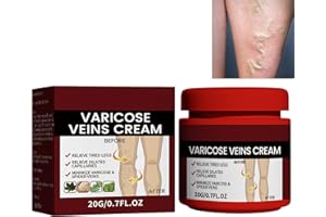 KOAHDE Cream for Varicose Veins in Legs,Varicose Veins Cream,Vein Relief Cream,Vein Cream for Legs,Varicose Veins Treatment Cream,Varicose Vein Removal Cream,Improve Blood Circulation,20G,1PC