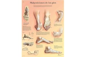 3B Scientific VR3185UU Impreso En Papel, Mal posiciones de los pies