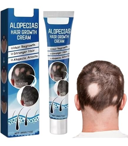 Alopecia Amazing Hair Growth by Alopecia : Amazon.co.uk: Beauty