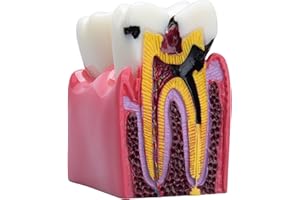 bcenyaz Dental Caries Teeth Model - Anatomy Education Model Caries Bilateral Comparison Study Model 6 Times Cross-Section Demonstration Model Tooth Decay Props for Science Teaching