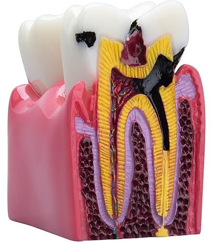 Teeth Periodontal Disease Model Dental Caries Breakdown Display Periodontitis Show Teaching Tooth Model Dentist Communication - View #9