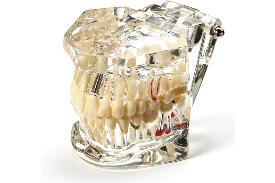 Uadme Standard Transparent Disease Teeth Model, with Implants & Removable Teeth, Tooth Pathological Teaching for Anatomy Demonstration, Disease Presentation & Implantology Study