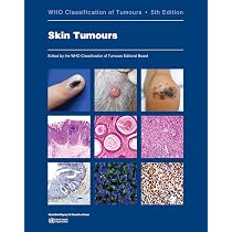 Buy Head and Neck Tumours: Who Classification of Tumours (World