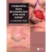 Local Flaps in Facial Reconstruction : Baker MD, Shan R.: Amazon